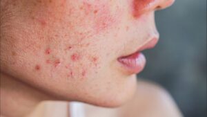 Home Remedies for Face Rash